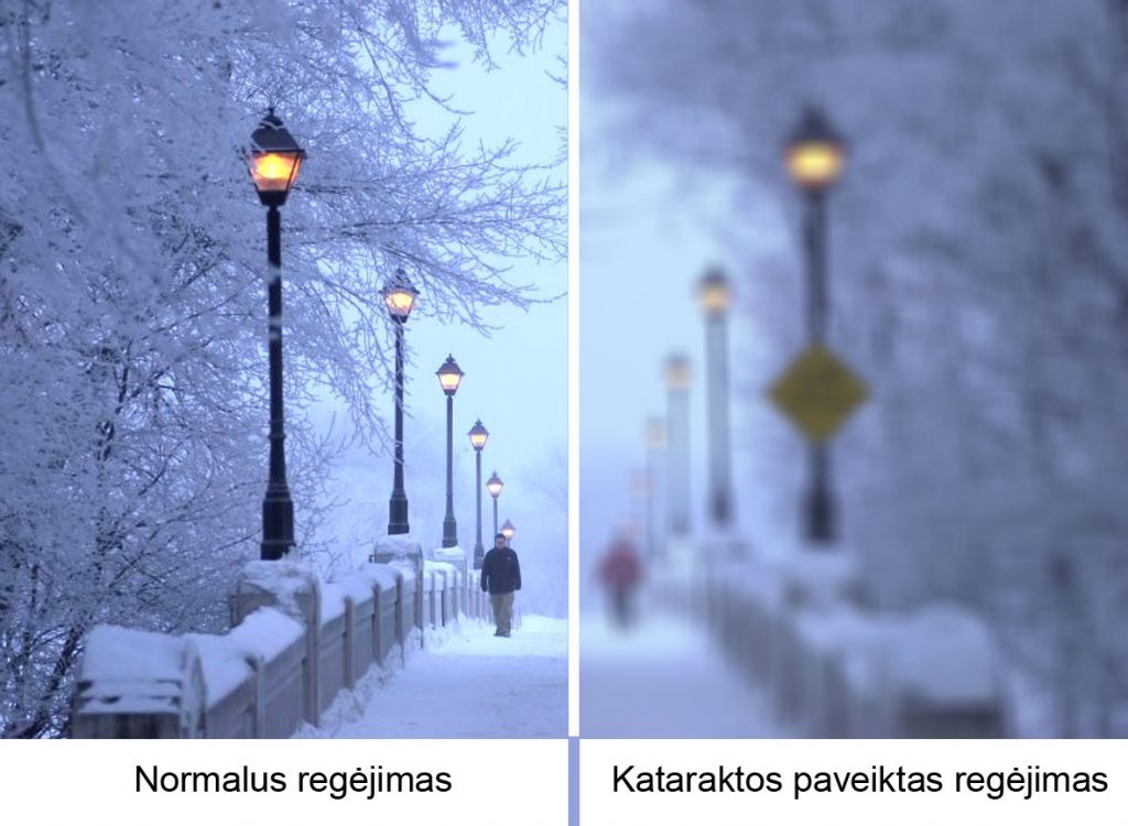 katarakta
